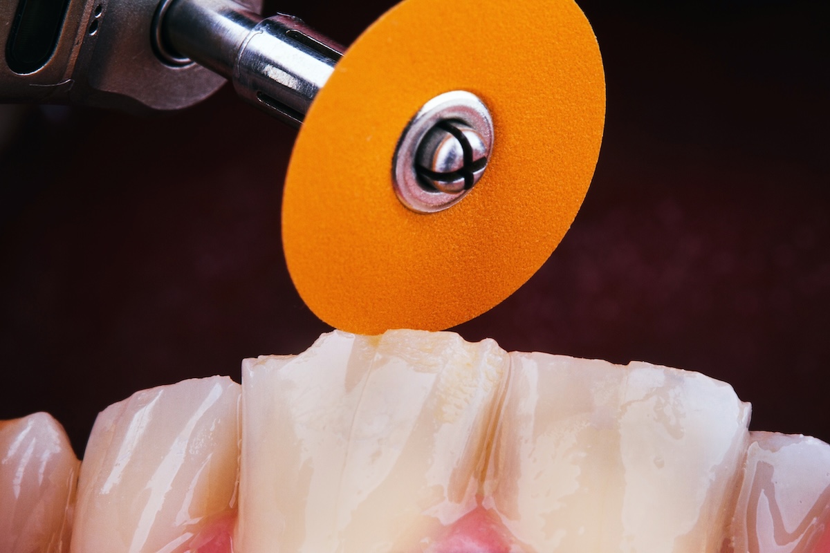 Bonding - Czy bonding jest odwracalny?